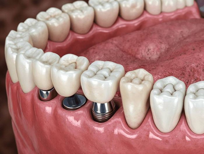 牙科种植体基台生物相容性检测