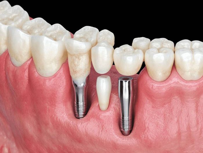 羟基磷灰石涂层植入物生物相容性检测